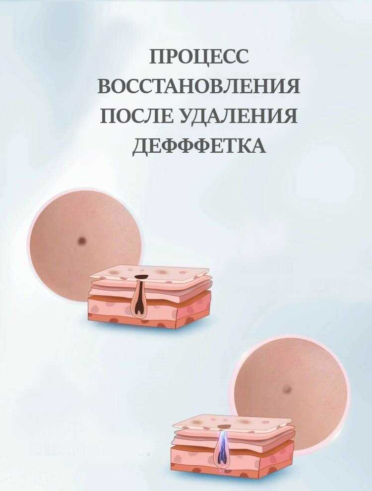 Лазерная ручка Коагулятор Дермапен (NL-01) фотография 9