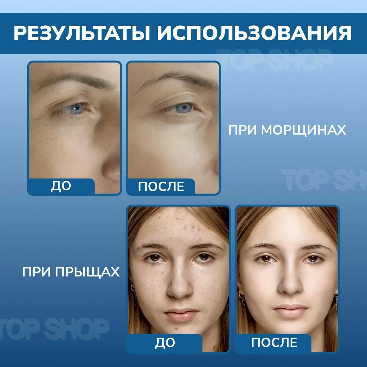 Дарсонваль Dr.Skin Care профессиональный аппарат для волос лица и тела фотография 16