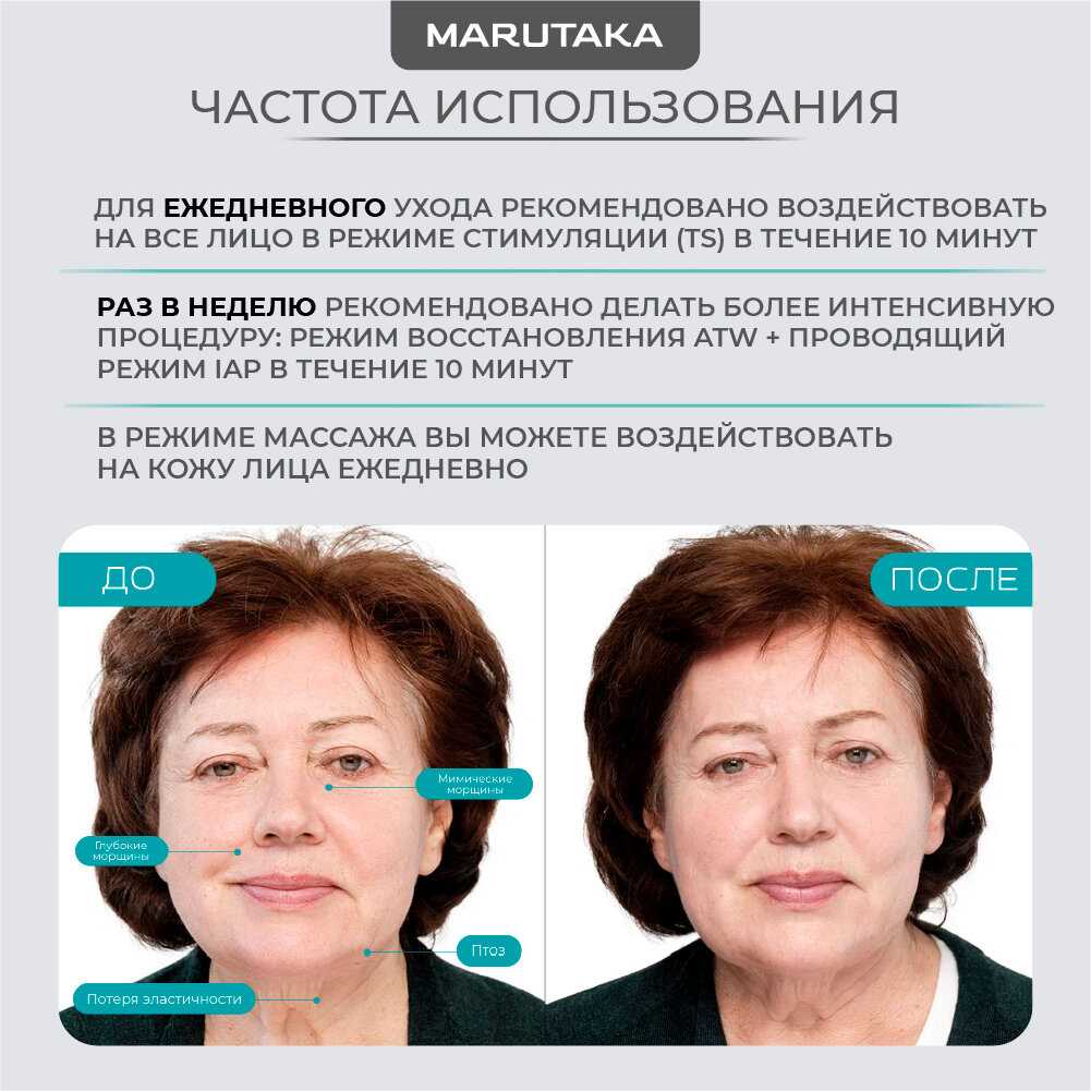 Аппарат для SMAS-лифтинга MARUTAKA LUXE фотография 6