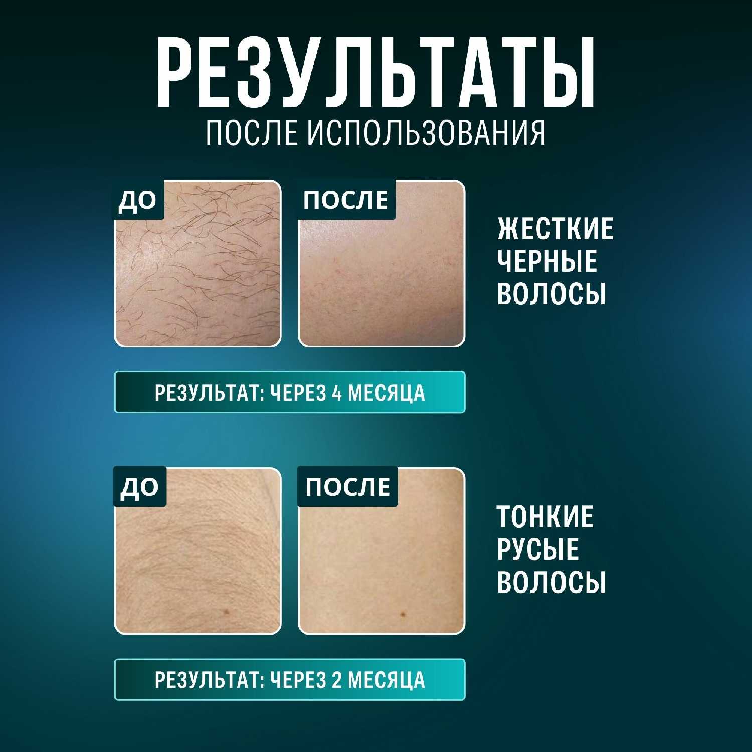 Эпилятор Сапфировый Эпилятор лазерный IPL фотография 4