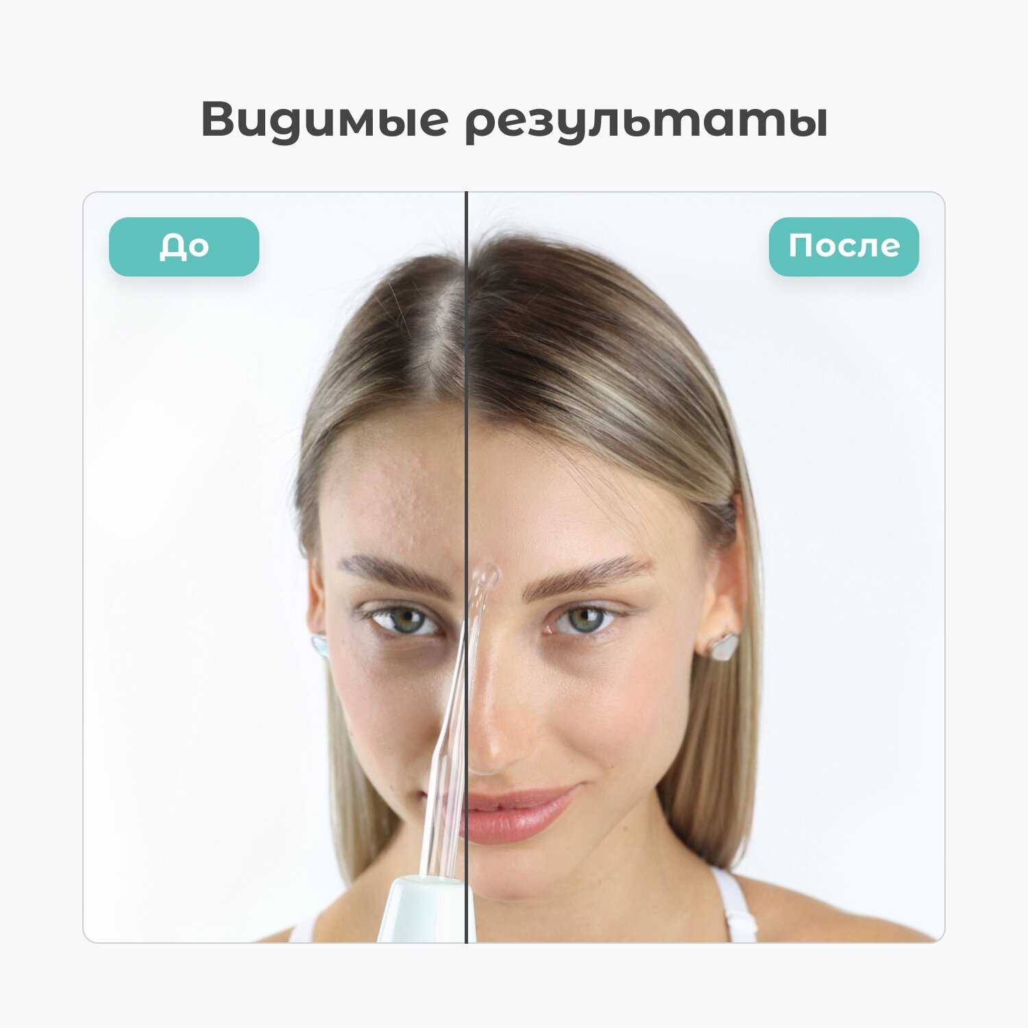 Дарсонваль Gezatone Biolift4 (118) фотография 12