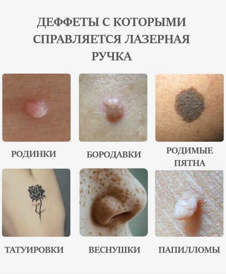 Лазерная ручка Коагулятор Дермапен (NL-01) фотография 1