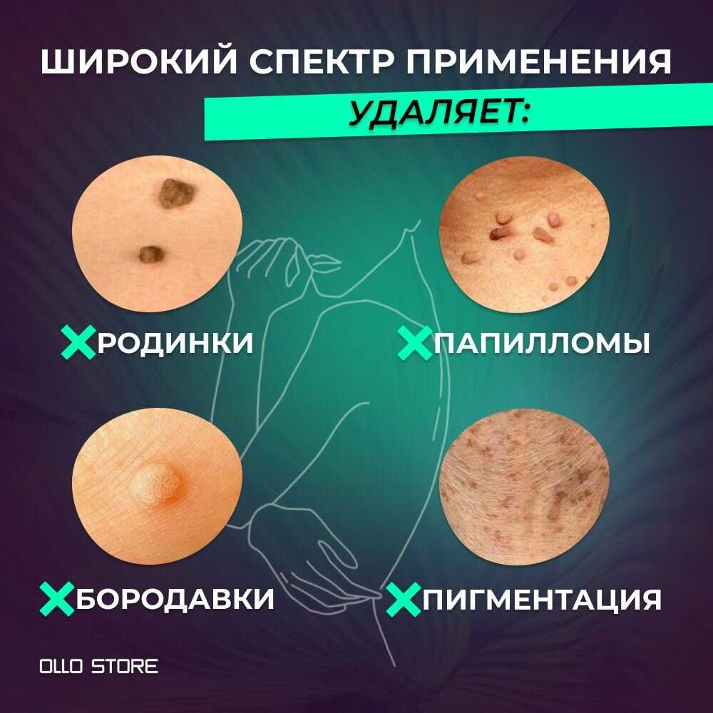 OLLO Store Плазменная ручка (Mole Freckle Removal Pen) фотография 1